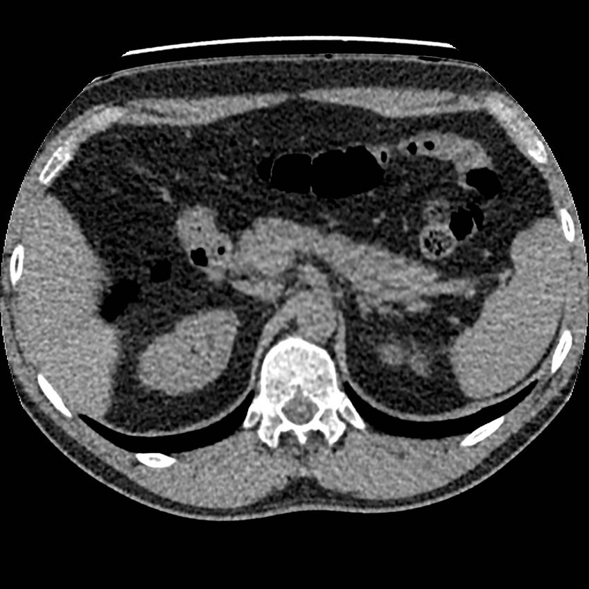 Obstructing ureteric calculus and ureteric anatomy (Radiopaedia 62730-71042 Axial non-contrast 14).jpg