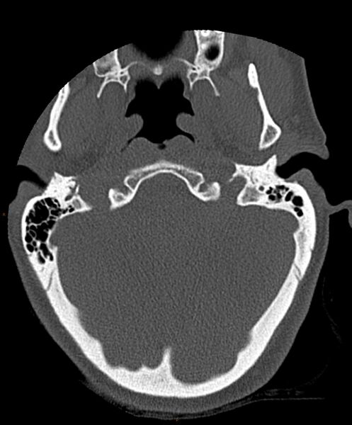 File:Occipital condyle fracture (Radiopaedia 61165-69056 D 4).jpg
