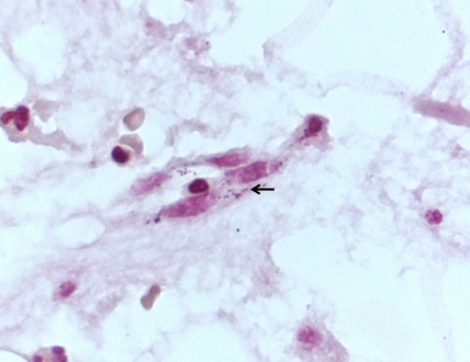 Brown-Brenn stain of L3-L4 vertebral bone showing intracellular Gram-negative coccobacillary bacteria arrow consistent with Coxiella burnetii