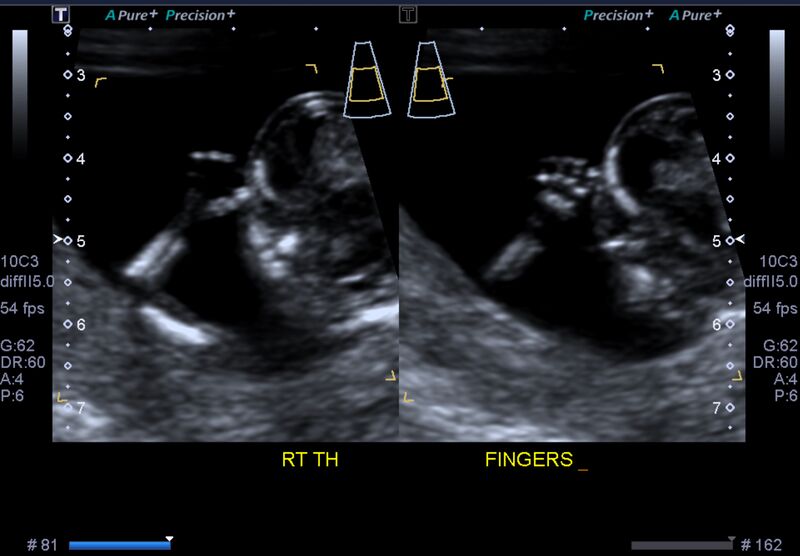 File:1st trimester nuchal-morphology ultrasound (Radiopaedia 44706-48477 General anatomy and NT 33).jpg