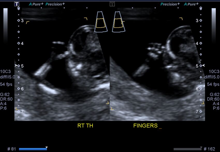 1st trimester nuchal-morphology ultrasound (Radiopaedia 44706-48477 General anatomy and NT 33).jpg