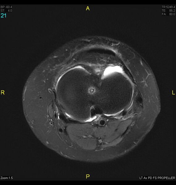 File:ACL mucoid degeration with cystic changes (Radiopaedia 48428-53341 Axial PD fat sat 18).jpg