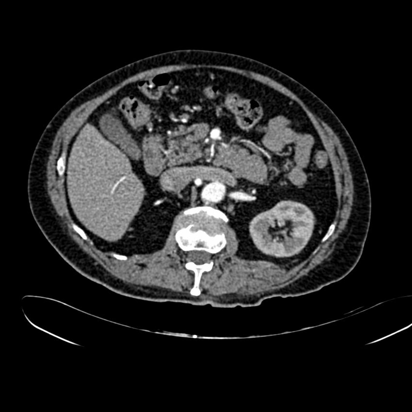 Abdominal aortic aneurysm (Radiopaedia 75131-86203 Axial C+ arterial phase 17).jpg