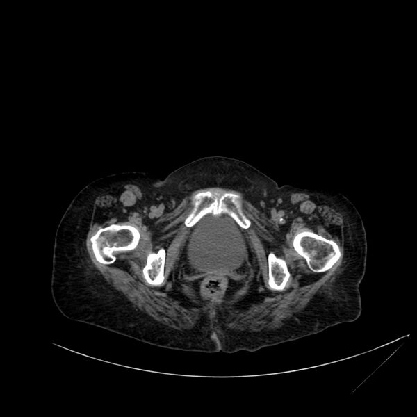 File:Abdominal aortic aneurysm - impending rupture (Radiopaedia 19233-19246 Axial non-contrast 126).jpg