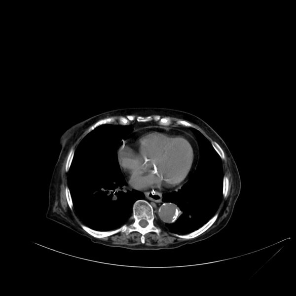 File:Abdominal aortic aneurysm - impending rupture (Radiopaedia 19233-19246 Axial non-contrast 9).jpg