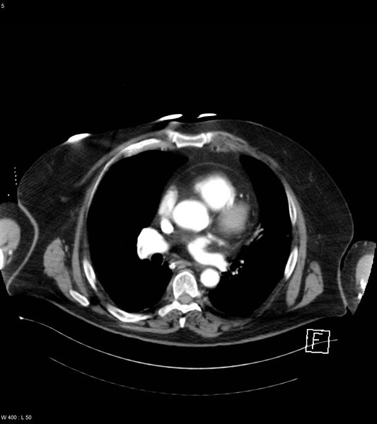File:Abdominal aortic aneurysm with intramural hematoma then rupture (Radiopaedia 50278-55632 Axial C+ arterial phase 4).jpg