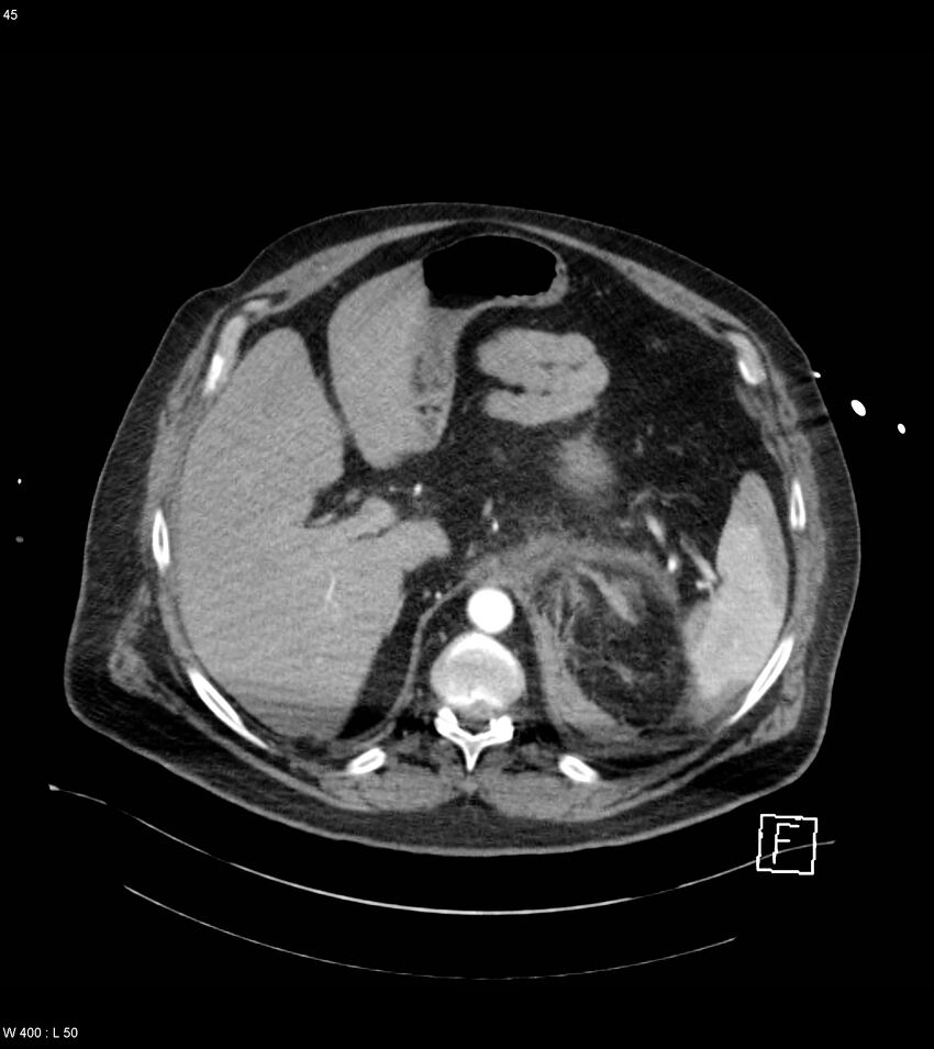 Abdominal aortic aneurysm with intramural hematoma then rupture (Radiopaedia 50278-55632 Axial C+ arterial phase 44).jpg