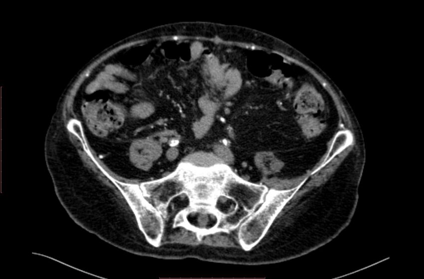 Abdominal aortic interposition tube graft and aneurysm thrombosis (Radiopaedia 71438-81857 Axial C+ arterial phase 149).jpg