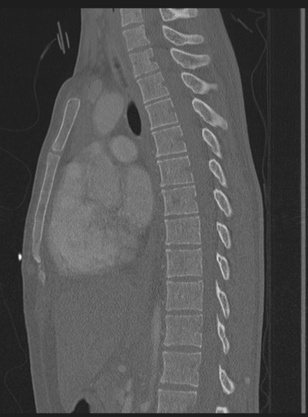 File:Abdominal multi-trauma - devascularised kidney and liver, spleen and pancreatic lacerations (Radiopaedia 34984-36486 Sagittal bone window 32).png