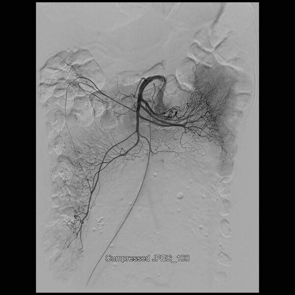 File:Abernethy malformation (Radiopaedia 42006-45462 Frontal Superior mesenteric artery 7).jpg