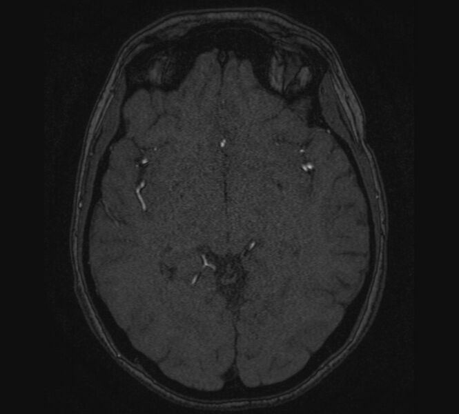 File:Accessory middle cerebral artery and ICA aneurysm (Radiopaedia 22656-22674 MRA 66).jpg