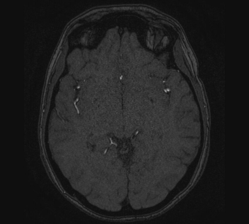 Accessory middle cerebral artery and ICA aneurysm (Radiopaedia 22656-22674 MRA 66).jpg
