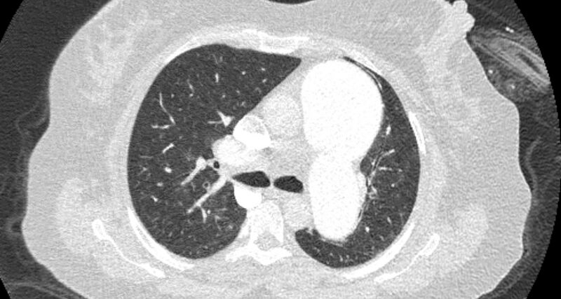 File:Accessory right inferior hepatic vein (Radiopaedia 65245-74259 Axial lung window 24).jpg