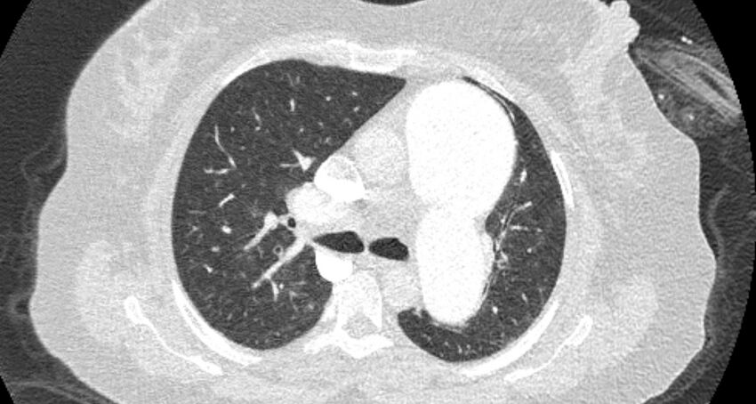 Accessory right inferior hepatic vein (Radiopaedia 65245-74259 Axial lung window 24).jpg