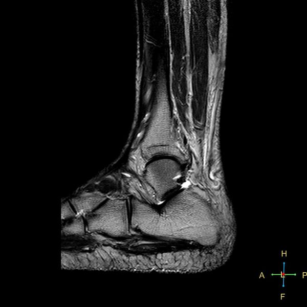 File:Achilles tendon complete tear (Radiopaedia 22834-22854 Sagittal T2 5).jpg