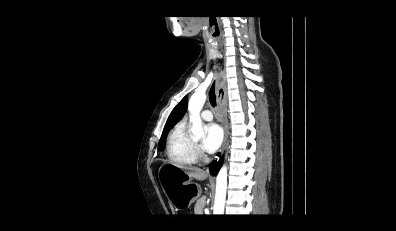 File:Acquired tracheo-esophageal fistula (Radiopaedia 51356-57103 Sagittal C+ arterial phase 7).jpg
