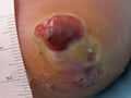 Acral lentignous melanoma (DermNet NZ lesions-melanoma-alm7).jpg