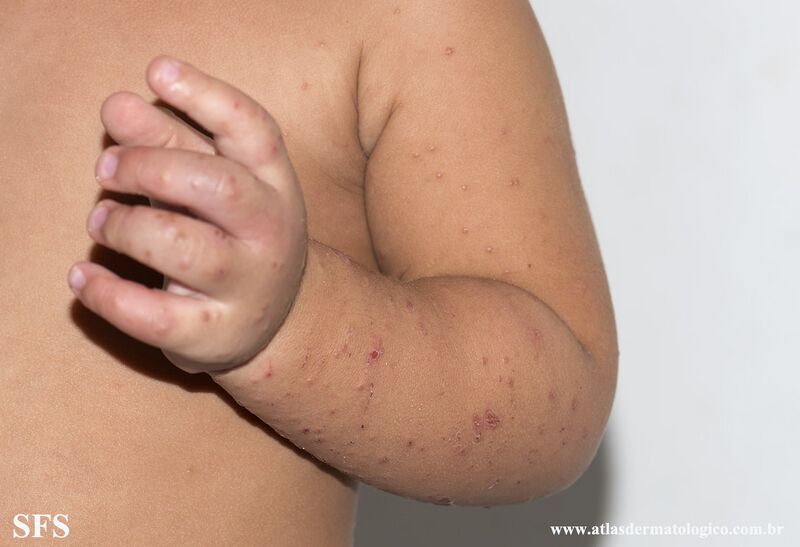 File:Acrodermatitis Infantile Papular (Dermatology Atlas 19).jpg