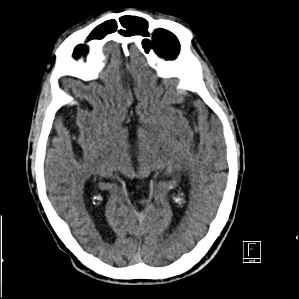 File:Acute ICA ischemic penumbra due to high-grade CCA stenosis (CT perfusion) (Radiopaedia 72038-82529 Axial non-contrast 21).jpg