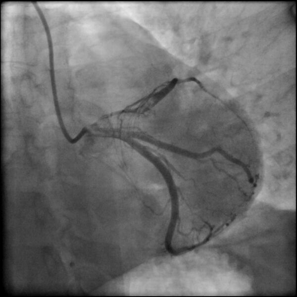 File:Acute anteroseptal myocardial infarction (Radiopaedia 68409-77946 LAO caudal (spider view) LAD and CX 39).jpg
