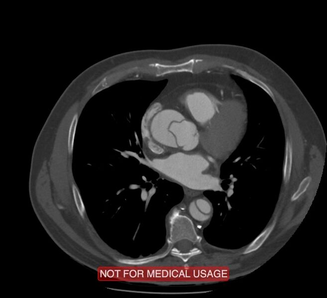 File:Acute aortic dissection - Stanford type A (Radiopaedia 40661-43285 Axial C+ arterial phase 36).jpg