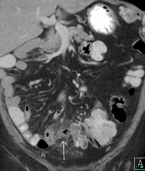 File:Acute appendicitis arising from a malrotated cecum (Radiopaedia 19970-19997 Coronal C+ portal venous phase 1).jpg
