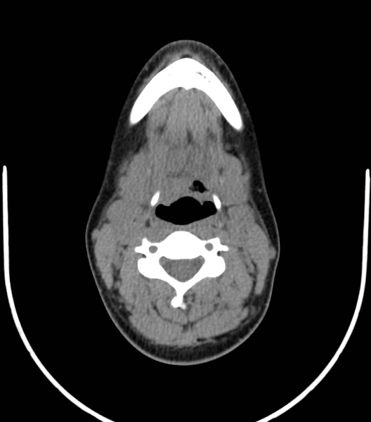 File:Acute bacterial tonsillitis (Radiopaedia 22882-22908 Axial non-contrast 31).png