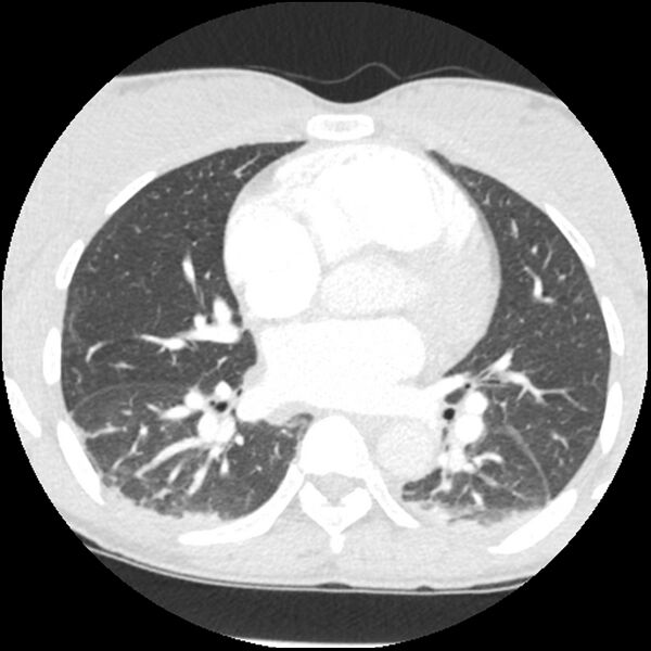 File:Acute chest syndrome - sickle cell disease (Radiopaedia 42375-45499 Axial lung window 104).jpg