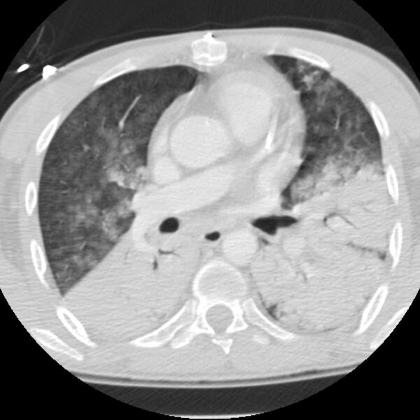 File:Acute diffuse alveolar hemorrhage (Radiopaedia 41323-44158 Axial lung window 28).jpg