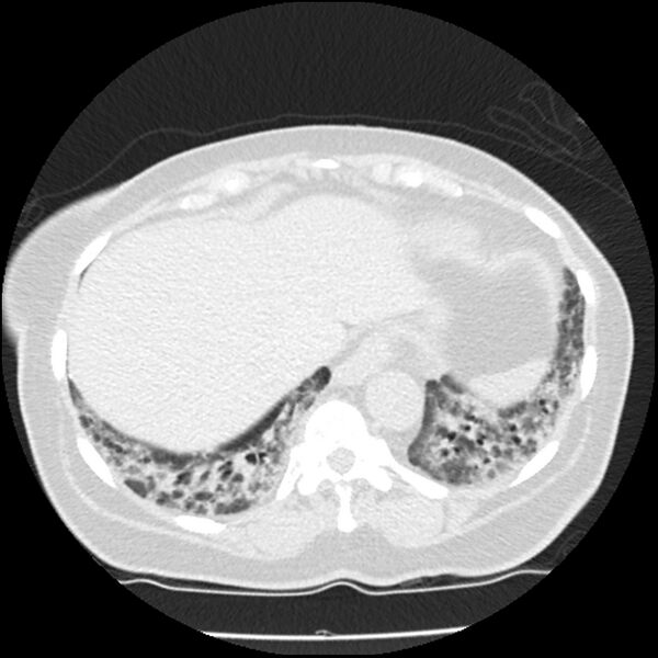File:Acute interstitial pneumonitis (Radiopaedia 45404-49444 Axial lung window 82).jpg