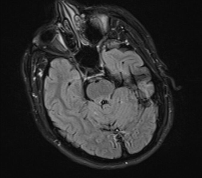 File:Acute ischemic stroke - posterior circulation territory (Radiopaedia 77670-89880 Axial FLAIR 8).jpg