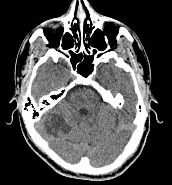 File:Acute ischemic stroke - posterior circulation territory (Radiopaedia 77670-89881 non-contrast 25).jpg