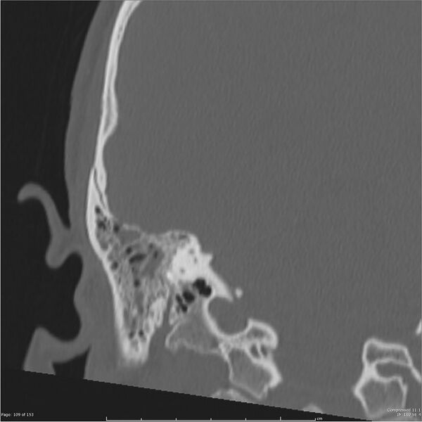 File:Acute otomastoiditis (Radiopaedia 28276-28512 Coronal PTB bone window reformat 40).jpg
