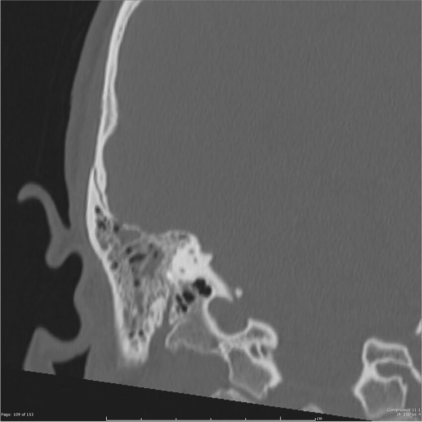 Acute otomastoiditis (Radiopaedia 28276-28512 Coronal PTB bone window reformat 40).jpg