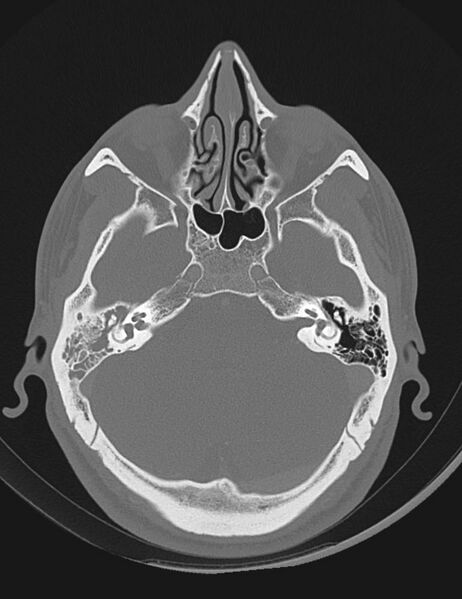 File:Acute otomastoiditis (Radiopaedia 28329-28575 Axial bone window 7).jpg