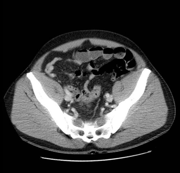 File:Acute pancreatitis - Balthazar E (Radiopaedia 23080-23110 Axial C+ portal venous phase 59).jpg