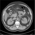 Acute pancreatitis - mild (Radiopaedia 27796-28033 Axial non-contrast 14).jpg