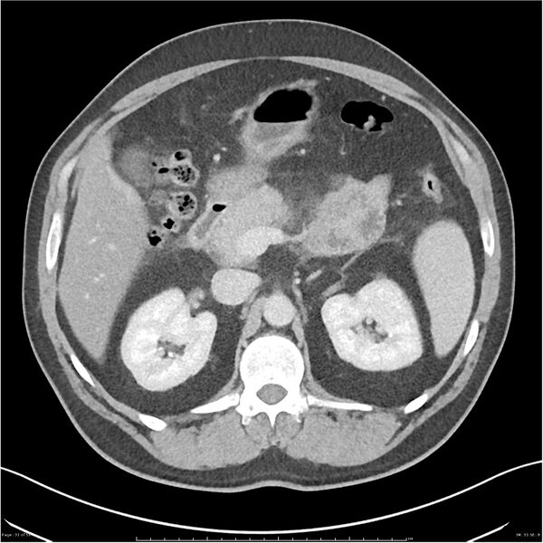 File:Acute pancreatitis - mild (Radiopaedia 27796-28033 C+ portal venous phase 12).jpg