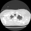 Acute pulmonary edema on CT (Radiopaedia 33582-34672 Axial lung window 4).jpg
