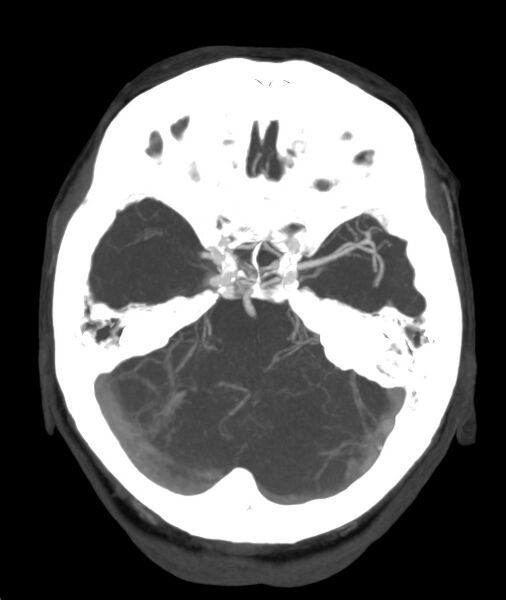 File:Acute right MCA M1 occlusion (Radiopaedia 62268-70454 Axial Phase 1 21).jpg