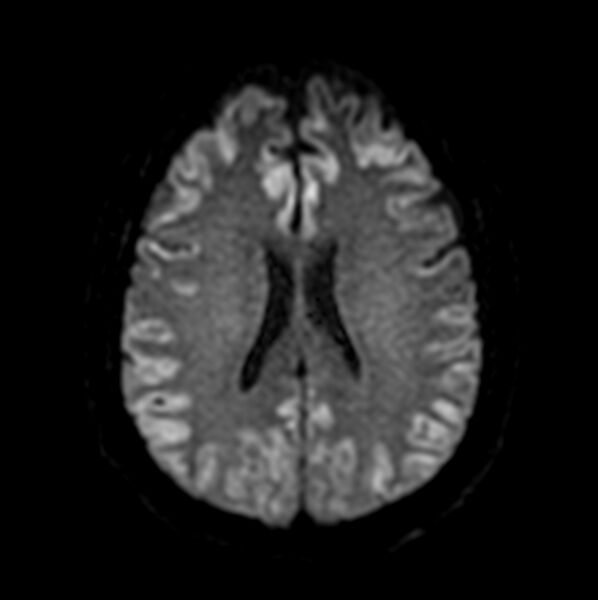 File:Acute severe hepatic encephalopathy (Radiopaedia 39037-41219 Axial DWI 21).jpg