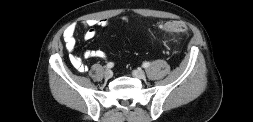 Acute sigmoid colon diverticulitis (Radiopaedia 55507-61976 Axial C+ portal venous phase 67).jpg
