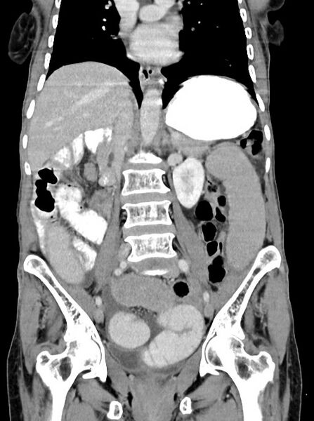 File:Acute small bowel (ileal) volvulus (Radiopaedia 71740-82139 Coronal C+ portal venous phase 63).jpg