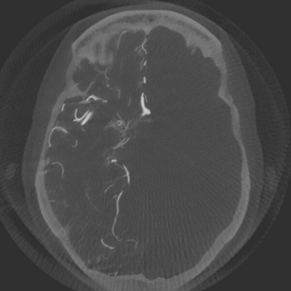 File:Acute subarachnoid hemorrhage and accessory anterior cerebral artery (Radiopaedia 69231-79010 Axial arterial - MIP 33).jpg