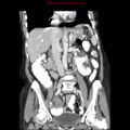 Adenocarcinoma of the colon (Radiopaedia 8191-9039 Coronal liver window 24).jpg