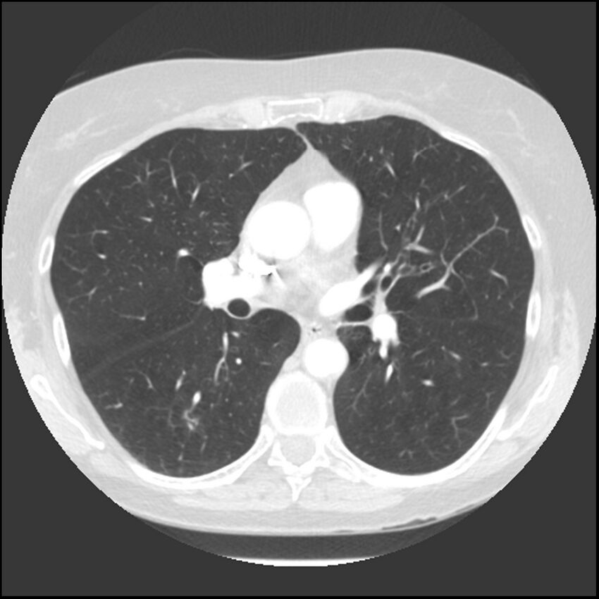 Adenocarcinoma of the lung (Radiopaedia 41015-43755 Axial lung window 58).jpg