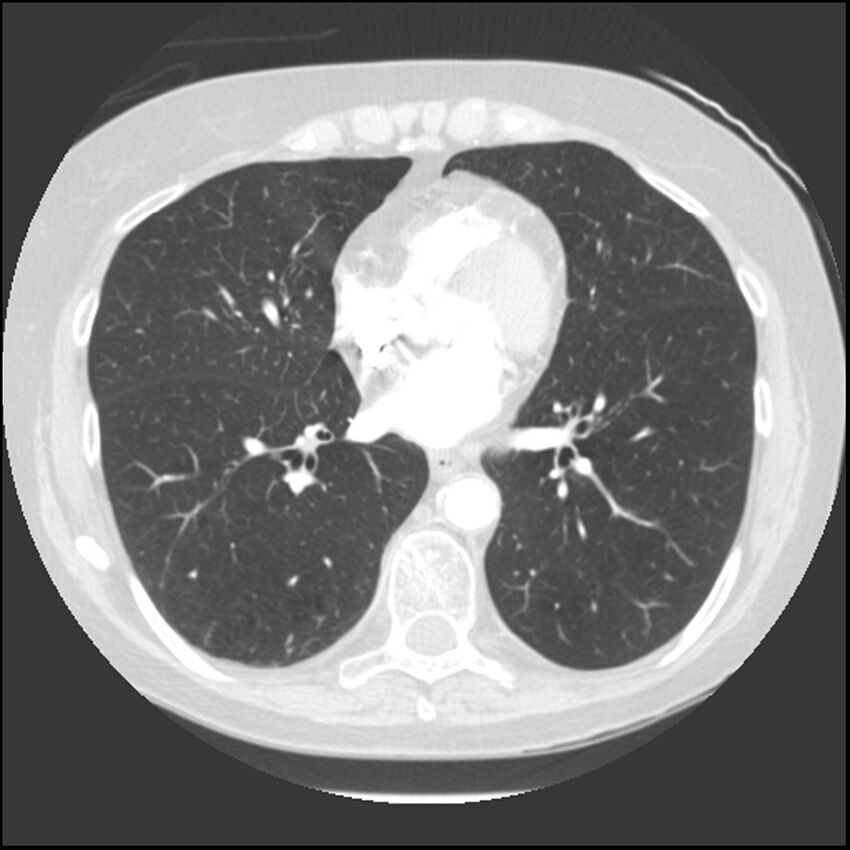 Adenocarcinoma of the lung (Radiopaedia 41015-43755 Axial lung window 74).jpg