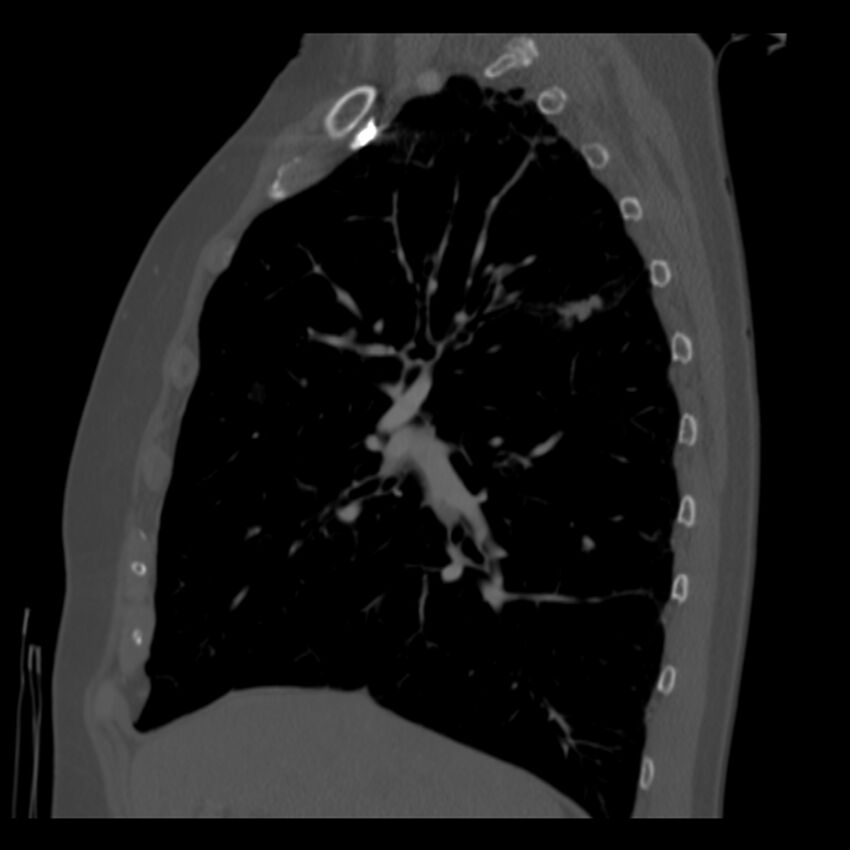 Adenocarcinoma of the lung (Radiopaedia 41015-43755 Sagittal bone window 35).jpg