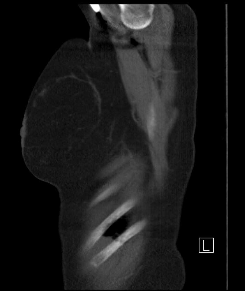 Adenocarcinoma of the lung (Radiopaedia 44205-47803 Sagittal C+ portal venous phase 55).jpg