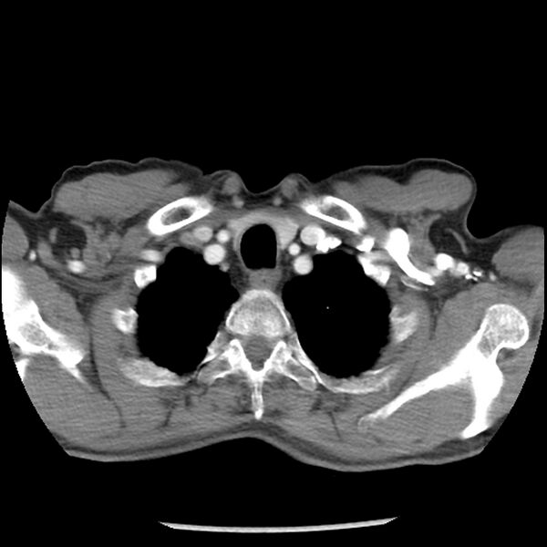 File:Adenocarcinoma of the lung - micropapillary predominant (Radiopaedia 42446-45563 Axial C+ portal venous phase 7).jpg
